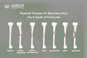 Physical Therapy for Recovery from the 8 Types of Fractures