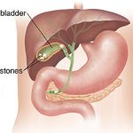 FIVE SAFE TIPS FOR THE PREVENTION OF GALLSTONE