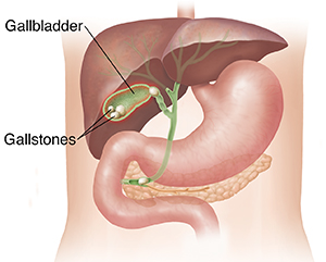 FIVE SAFE TIPS FOR THE PREVENTION OF GALLSTONE